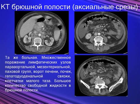 Показания для КТ брюшной и забрюшинной полости