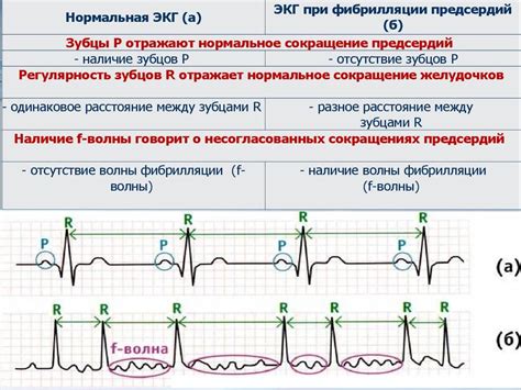 Понятие и проявления ускоренного предсердного ритма на ЭКГ