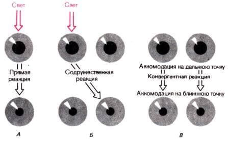 Поражение зрачковых мускулов