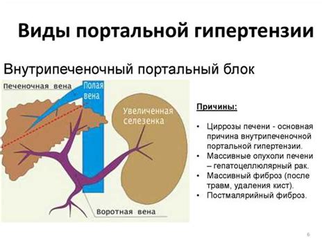 Портальная гипертензия: что это и как она проявляется