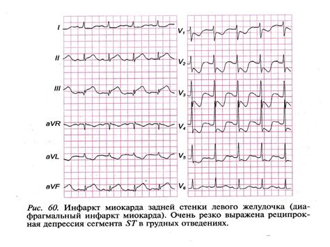 Последствия изменений миокарда нижней стенки левого желудочка
