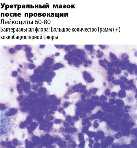 Последствия наличия коккобациллярной флоры в мокроте