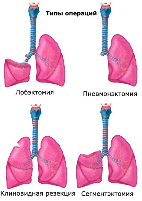 Последствия неравномерной пневматизации легких