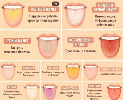 Последствия отсутствия профилактики коричневого налета на языке