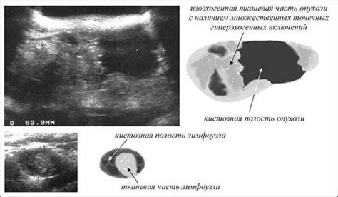 Последствия повышенной эхогенности почечных синусов