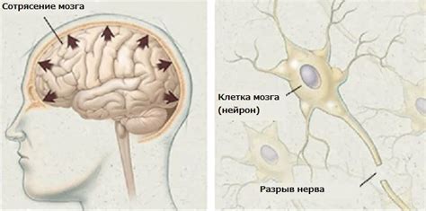 Последствия уснувшего при сотрясении мозга