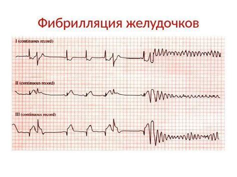 Последствия фибрилляции желудочков