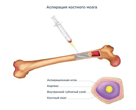 Потенциальные осложнения после пункции костного мозга у детей