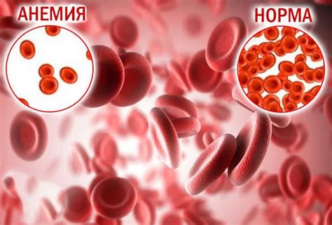 Потенциальные причины и последствия анемии у мужчин