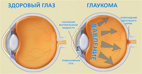 Появление глаукомы