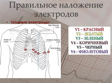 Правильная установка электродов