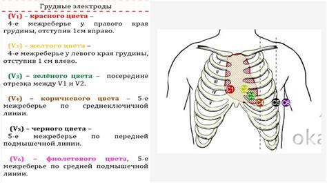 Правильное размещение электродов на теле