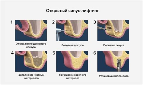 Преимущества и недостатки открытого синус лифтинга