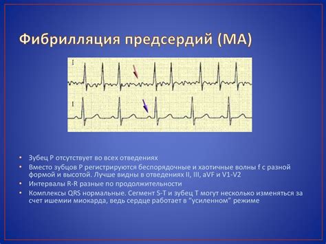 Признаки и диагностика фибрилляции предсердий