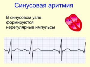 Признаки синусовой аритмии у ребенка 11 лет