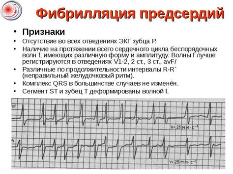 Признаки фибрилляции на ЭКГ