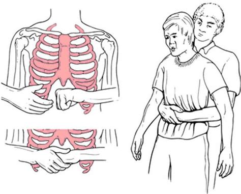 Применение техники Хаймлиха