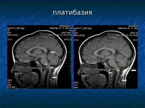 Причины венозной аномалии развития головного мозга