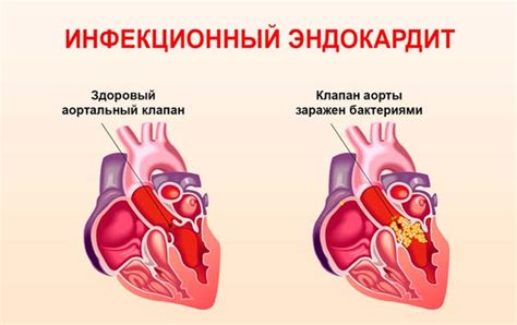 Причины возникновения бактериального эндокардита у женщин