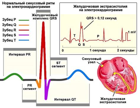 Причины возникновения желудочковой экстрасистолии бигеминия