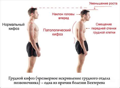 Причины возникновения кифотической осанки