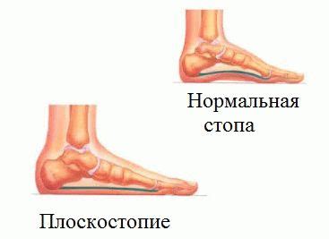 Причины возникновения натоптышей