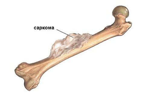 Причины возникновения оценки поражения кости