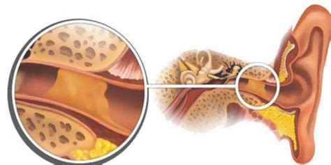 Причины возникновения патологического субстрата в ухе