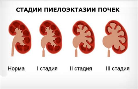 Причины возникновения пиелоэктазии