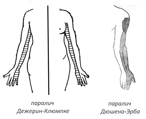 Причины возникновения плексопатии