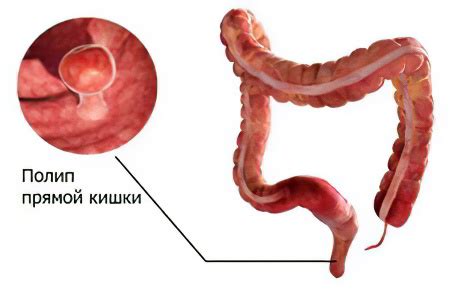 Причины возникновения полипов на почке