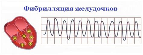 Причины возникновения фибрилляции желудочков