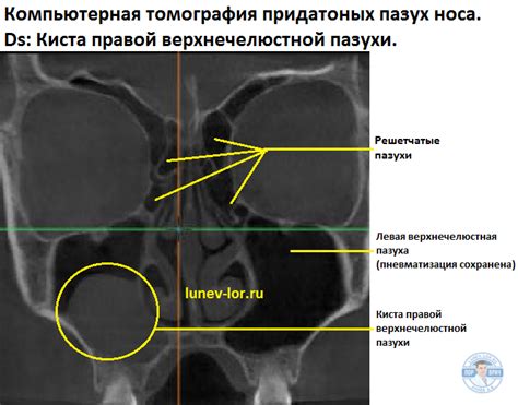 Причины гомогенного затемнения левой верхнечелюстной пазухи