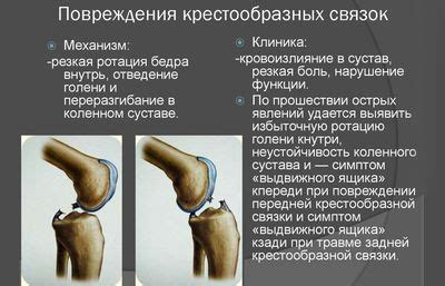 Причины дегенеративных изменений передней крестообразной связки