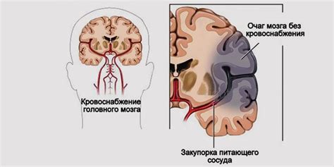 Причины дисциркуляции в вертебро-базилярном бассейне