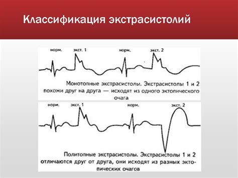 Причины желудочковой экстрасистолии по типу тригеминии