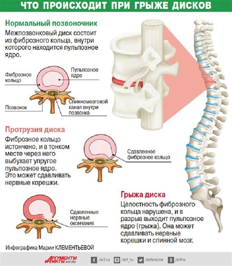 Причины и симптомы грыжи позвоночника