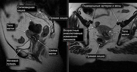 Причины клетчатки малого таза у женщин