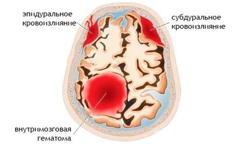 Причины кровоизлияния в мозг