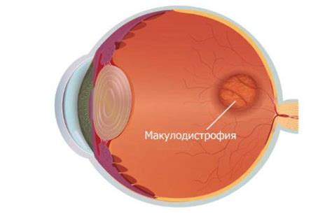 Причины макулодистрофии сетчатки