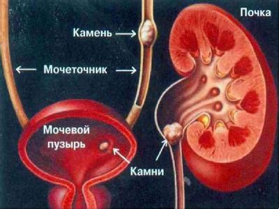 Причины образования мочевого камня