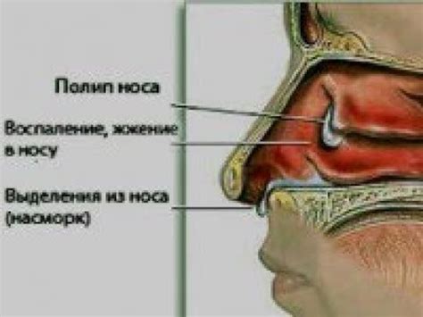 Причины образования слизи в носовых пазухах