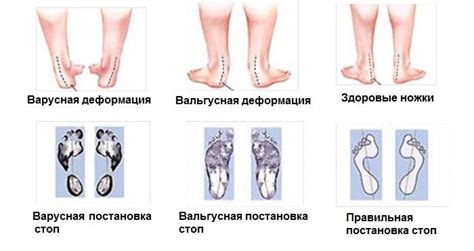 Причины переувлажнения стопы