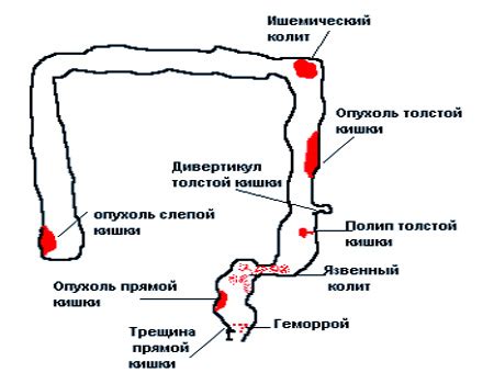 Причины появления мелких и крупных палочек в кале