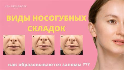 Причины появления носогубных складок и как на них влияют различные факторы