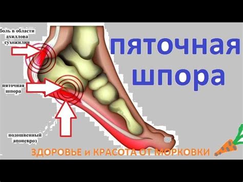 Причины появления шпоры на пятке