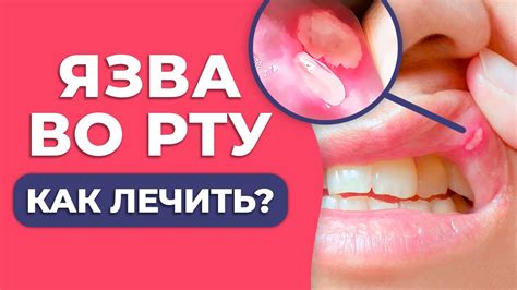 Причины появления язв во рту у детей