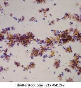 Причины появления squamous epithelial cells в моче