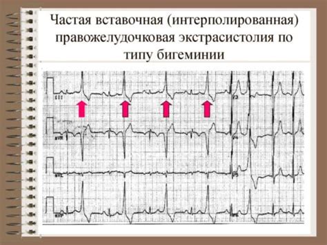 Причины предсердной экстрасистолии по типу бигеминии