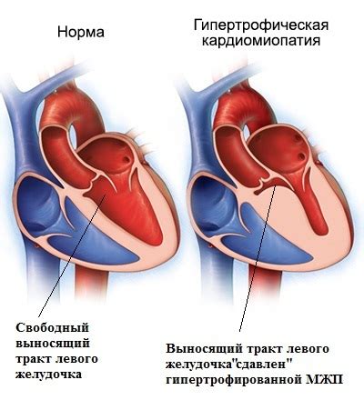 Причины преобладания активности левого желудочка